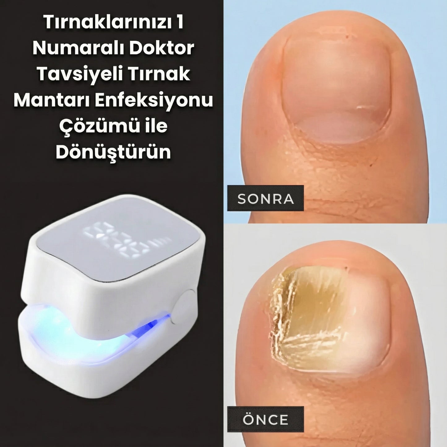 PureNail™ – Lazerli Tırnak Terapi Cihazı