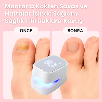 PureNail™ – Lazerli Tırnak Terapi Cihazı